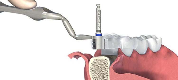 Dr. Renato Alcantara - Cirurgia guiada